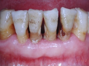 腸活での歯のホワイトニングの失敗
