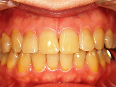腸活での歯の黄ばみ